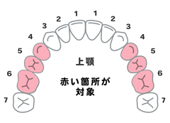 銀歯が気になっていませんか？―保険でできる白い歯―