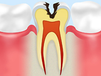 C2（象牙質の虫歯）