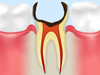 C4（歯根まで達した虫歯）