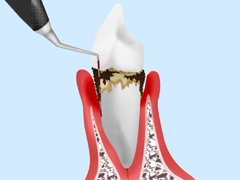 歯周ポケットの検査 