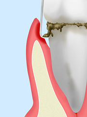 歯周ポケット掻把（そうは）術